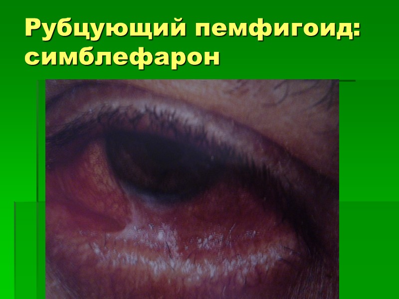 Рубцующий пемфигоид: симблефарон